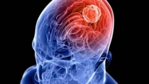 Allarme neurodisabilit&agrave; da ictus